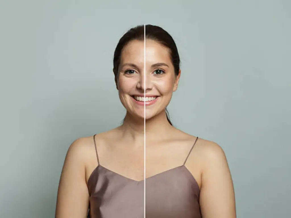 Détails des résultats du soin du visage au laser CO2