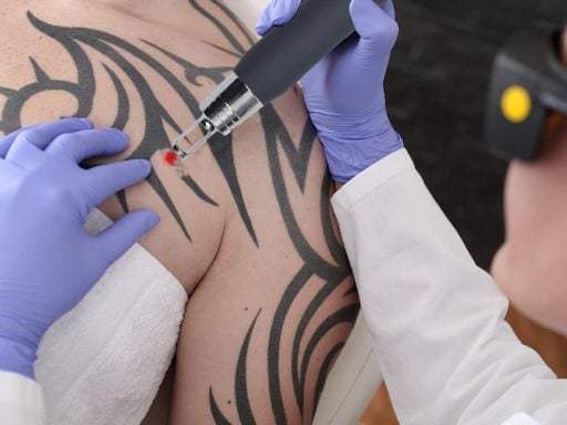 Pico laser tattoo verwijdering machine EN113 1