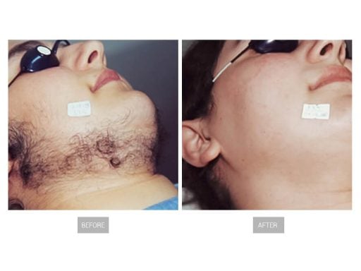 depilación antes y después 2