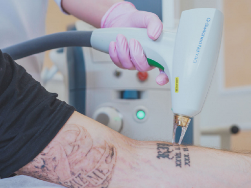 nd yag laser tattoo verwijderen 1