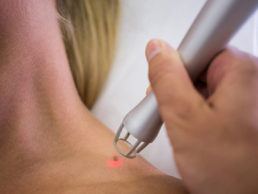 láser de picosegundos