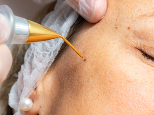 удаление плазменных родинок