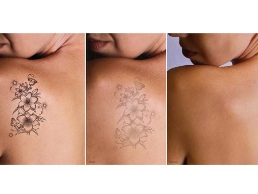 rimozione del tatuaggio 3