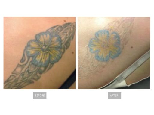 tatoeage verwijderen voor en na 4